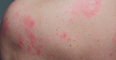 Jak skutecznie i szybko pokonać pokrzywkę kontaktową? Czy pokrzywka to zawsze alergia?
