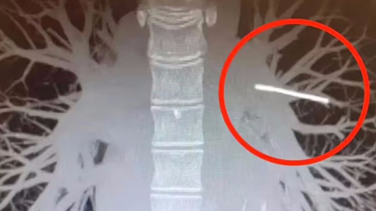 Implant antykoncepcyjny matki przemieścił się z ramienia. Lekarze znaleźli go w nieoczekiwanym miejscu