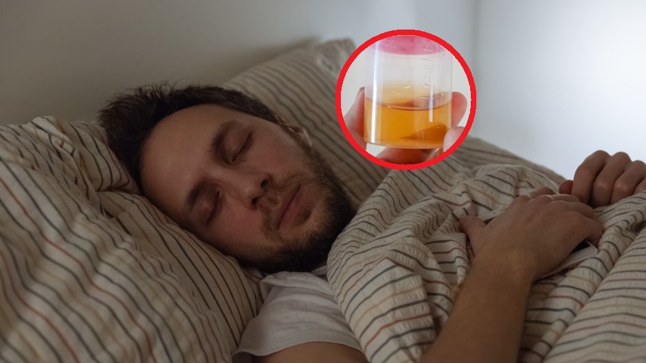 Zmiana koloru moczu może świadczyć o raku trzustki