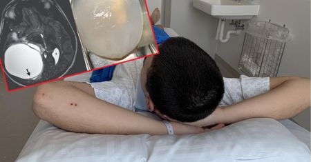 14-latek zakaził się groźnym pasożytem. Wycieli mu to z mózgu