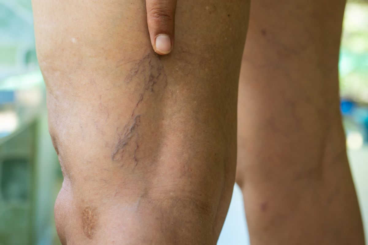 How to get rid of spider veins?