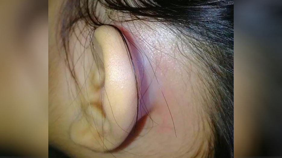 Objaw, który łatwo przeoczyć. Świadczy o groźnym schorzeniu