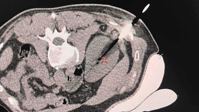 Zdjęcie z operacji Krioablacji