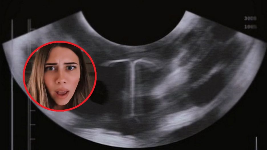Myślała, że podczas badania USG widzi spiralę. Prawda okazała się zupełnie inna