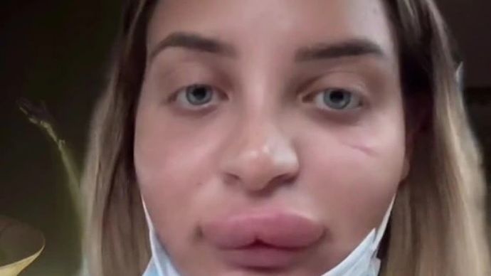 Pokazała jaka może być reakcja po usunięciu wypełniaczy z ust