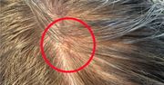 Ukrywają się we włosach, mogą być śmiertelnie groźne. Oto "zaćmienie słońca"
