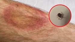 Kleszcze atakują. Dramatyczny wzrost przypadków boreliozy