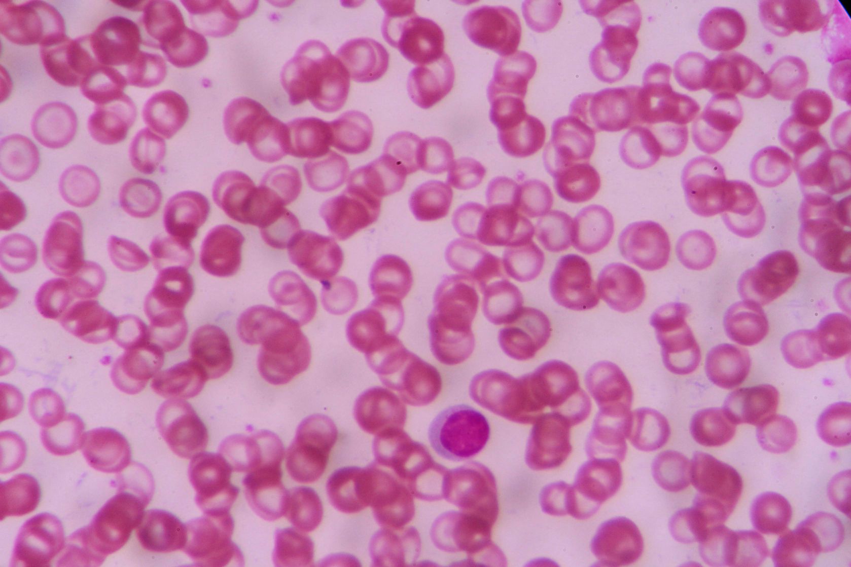 RDW jest wskażnikiem wielkości czerwonych krwinek