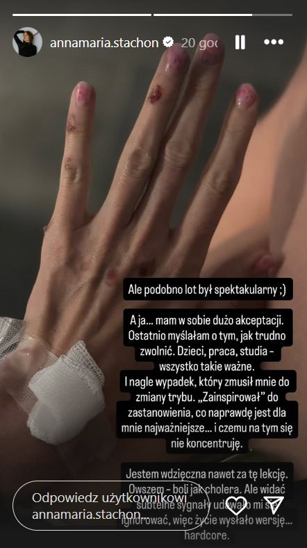 Anna-Maria Stachoń pokazała zdjęcia po wypadku