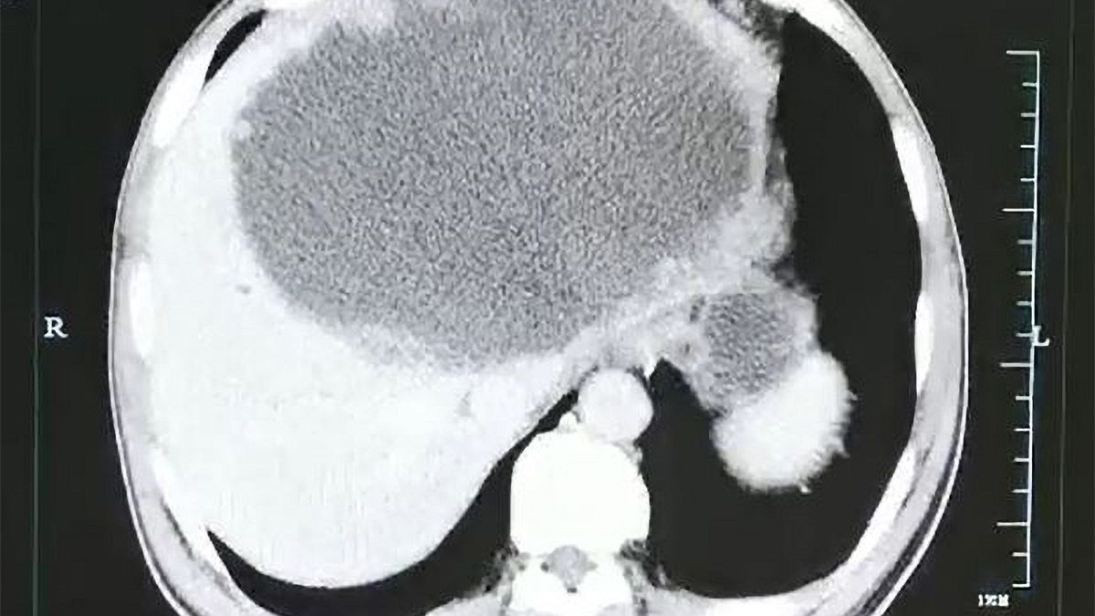 Pasożyt zaatakował wątrobę