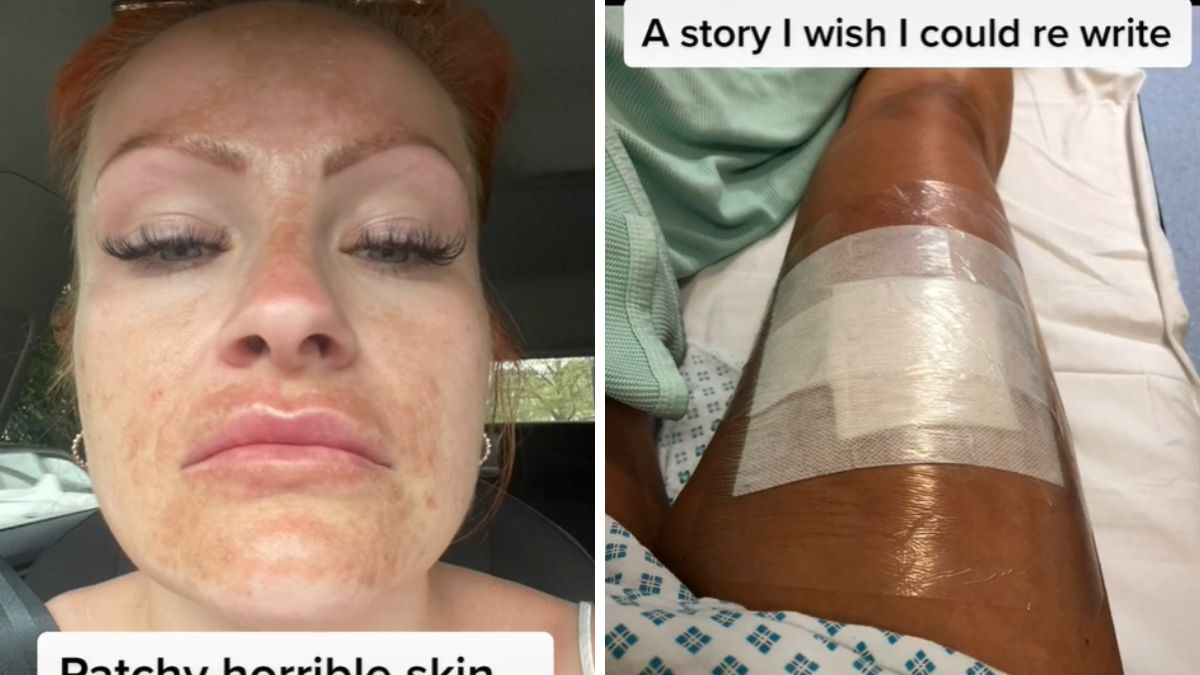 Opalanie spowodowało u niej raka skóry