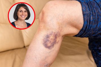 Takie siniaki mogą być groźne. Hematolożka wskazuje przyczyny