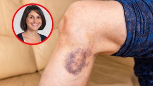Takie siniaki mogą być groźne. Hematolożka wskazuje przyczyny