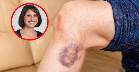 Takie siniaki mogą być groźne. Hematolożka wskazuje przyczyny