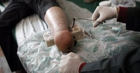 Obciął sobie stopę, żeby nie pracować!