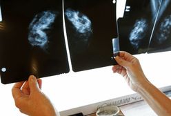 Rak piersi główną przyczyną zgonów kobiet po 35. roku życia