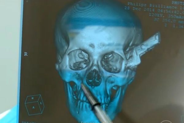 Ostrze noża przebiło czaszkę, mijając o centymetry lewe oko