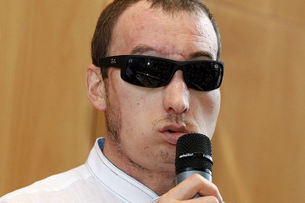 33-letni Grzegorz, któremu w maju przeszczepiono twarz w Centrum Onkologii w Gliwicach