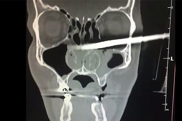 Pacjent z prętem w czaszce. Lekarze z Białegostoku usunęli ciało obce