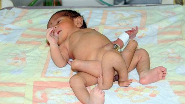 Dziecko jest już po operacji