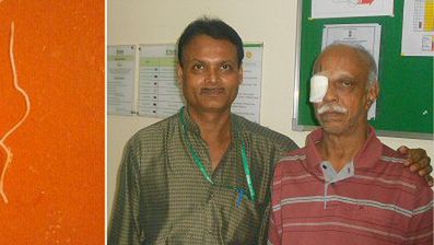 12,5-centymetrowego robaka usunięto z oka 75-latka