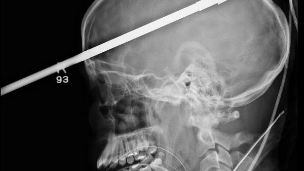 Na rentgenowskim zdjęciu widać, że harpun przebił nastolatkowi głowę na wylot