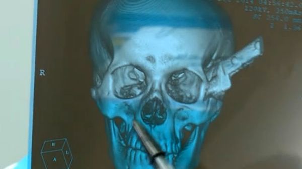 Ostrze noża przebiło czaszkę, mijając o centymetry lewe oko