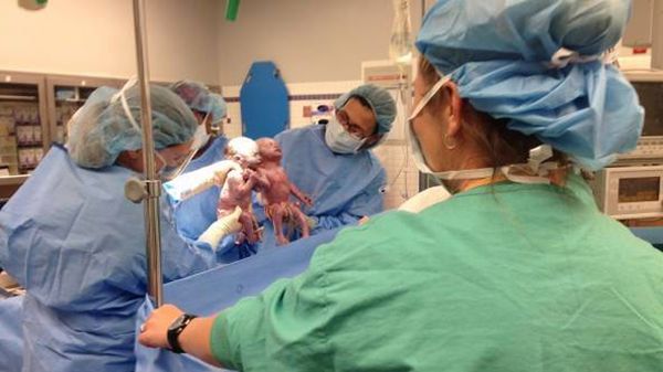 Ciąża bliźniacza była zagrożona, poród nastąpił przez cesarskie cięcie