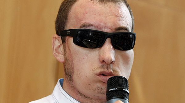 33-letni Grzegorz, któremu w maju przeszczepiono twarz w Centrum Onkologii w Gliwicach