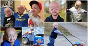Progeria - przedwczesna starość