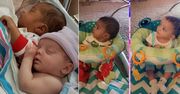 Nietypowe bliźnięta. Mają różne kolory skóry