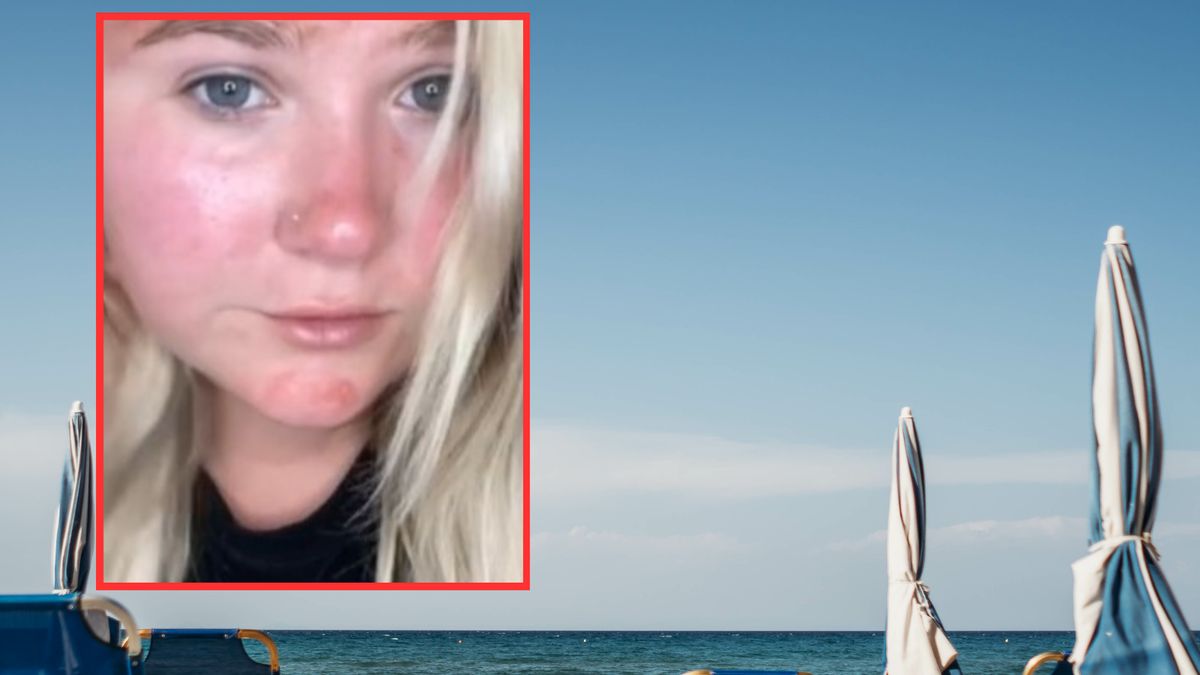 Krem przeciwsłoneczny oszpecił jej twarz. Był przeterminowany. 