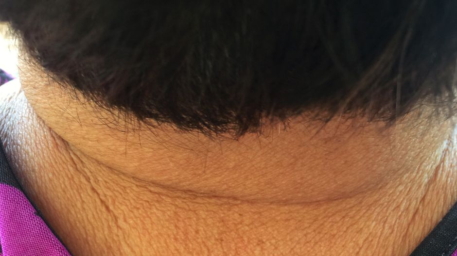 Jakie objawy daje cukrzyca?