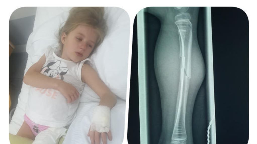 Maja cierpi na skoliozę i wrodzoną łamliwość kości