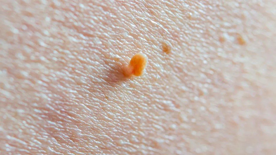 Czy włókniaki są groźne?