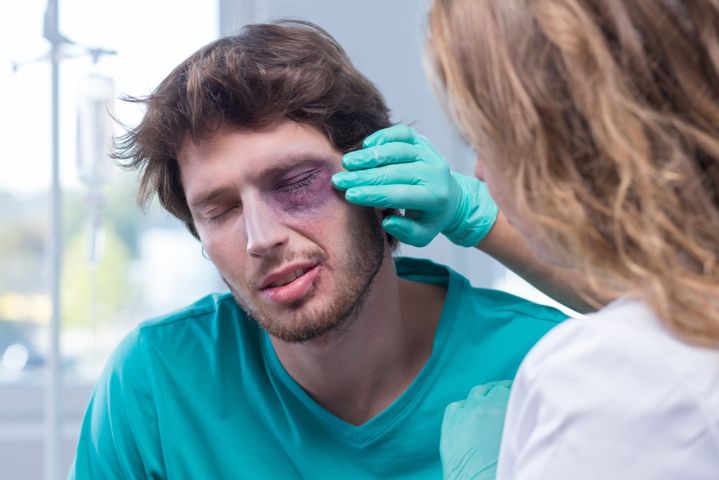 Podbite oko to najczęściej skutek uderzenia bądź upadku.