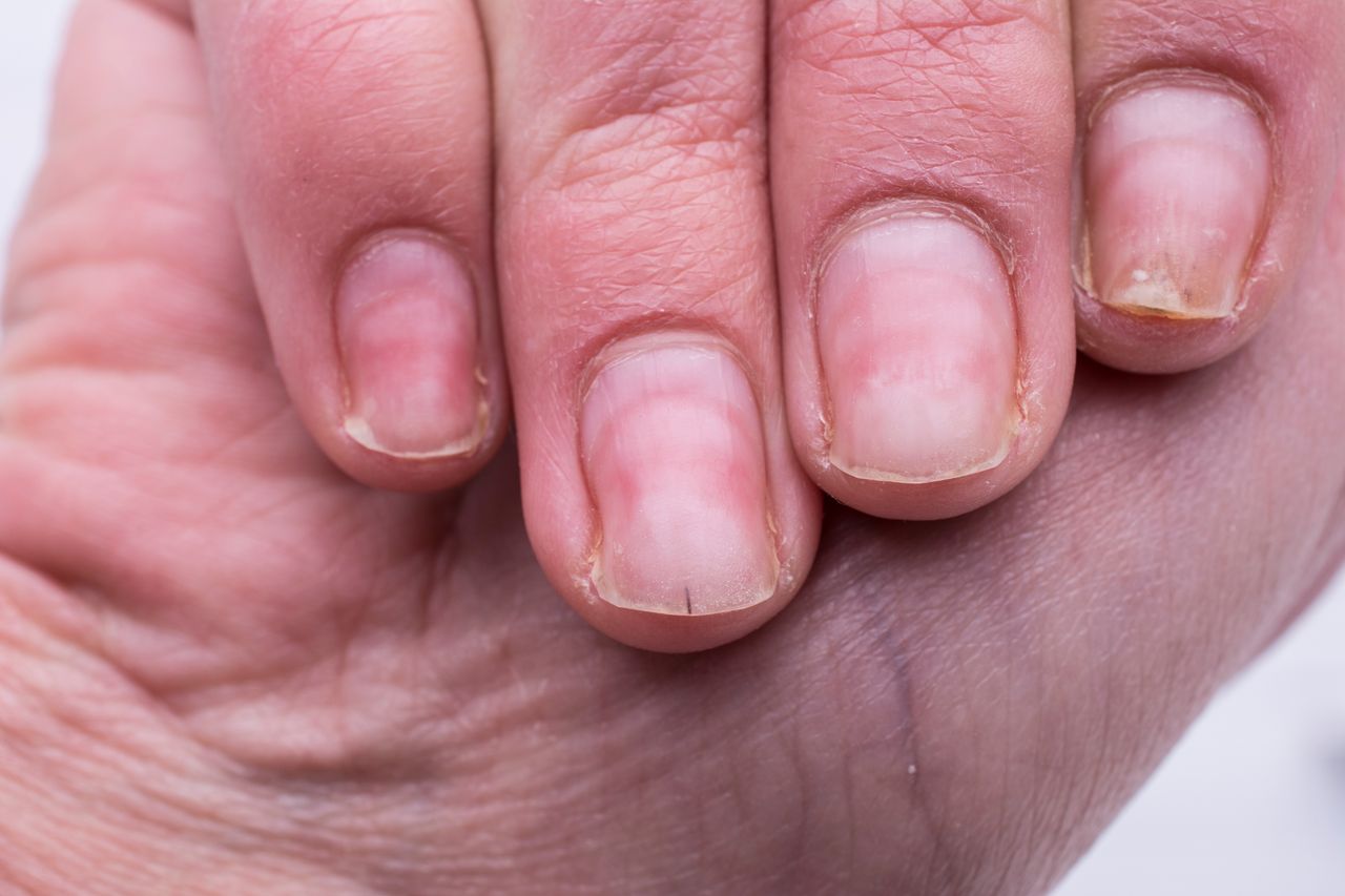 Znak choroby na paznokciach. Zagrożone serce, nerki lub wątroba
