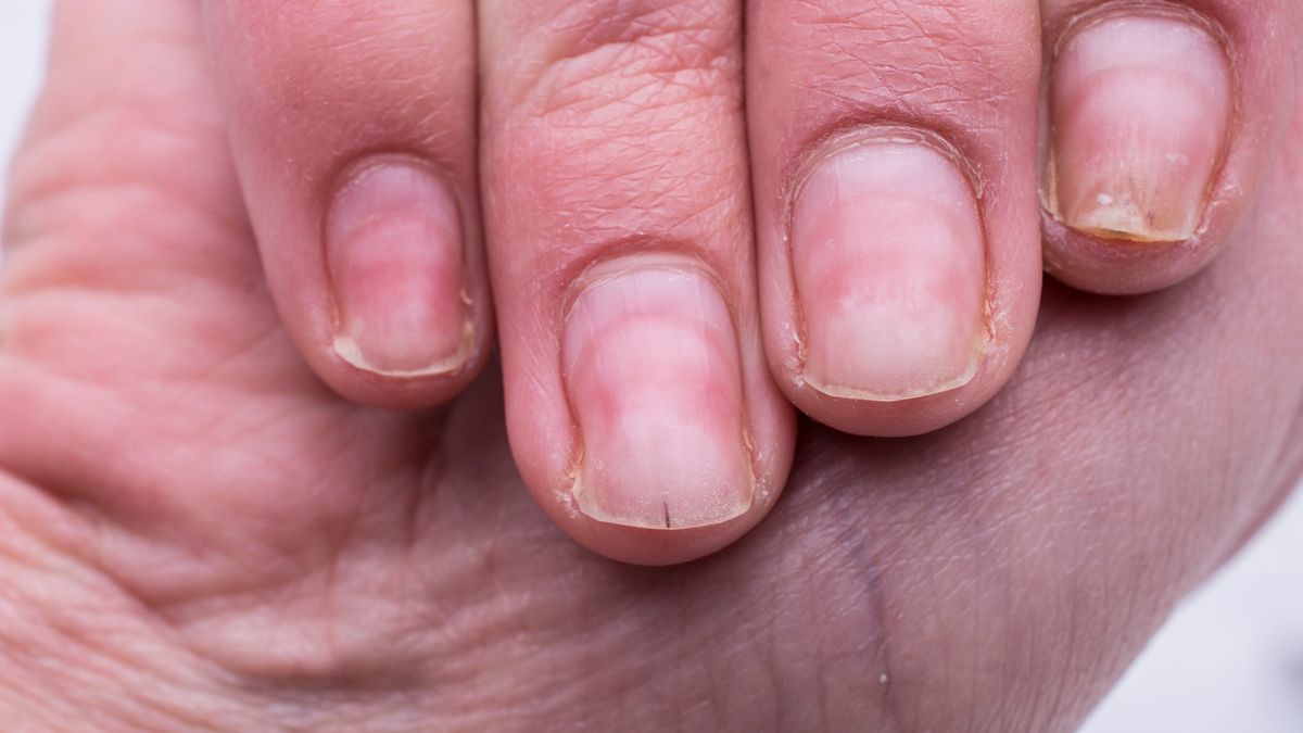 Niepozorna zmiana na paznokciach może mieć związek z niewydolnoś