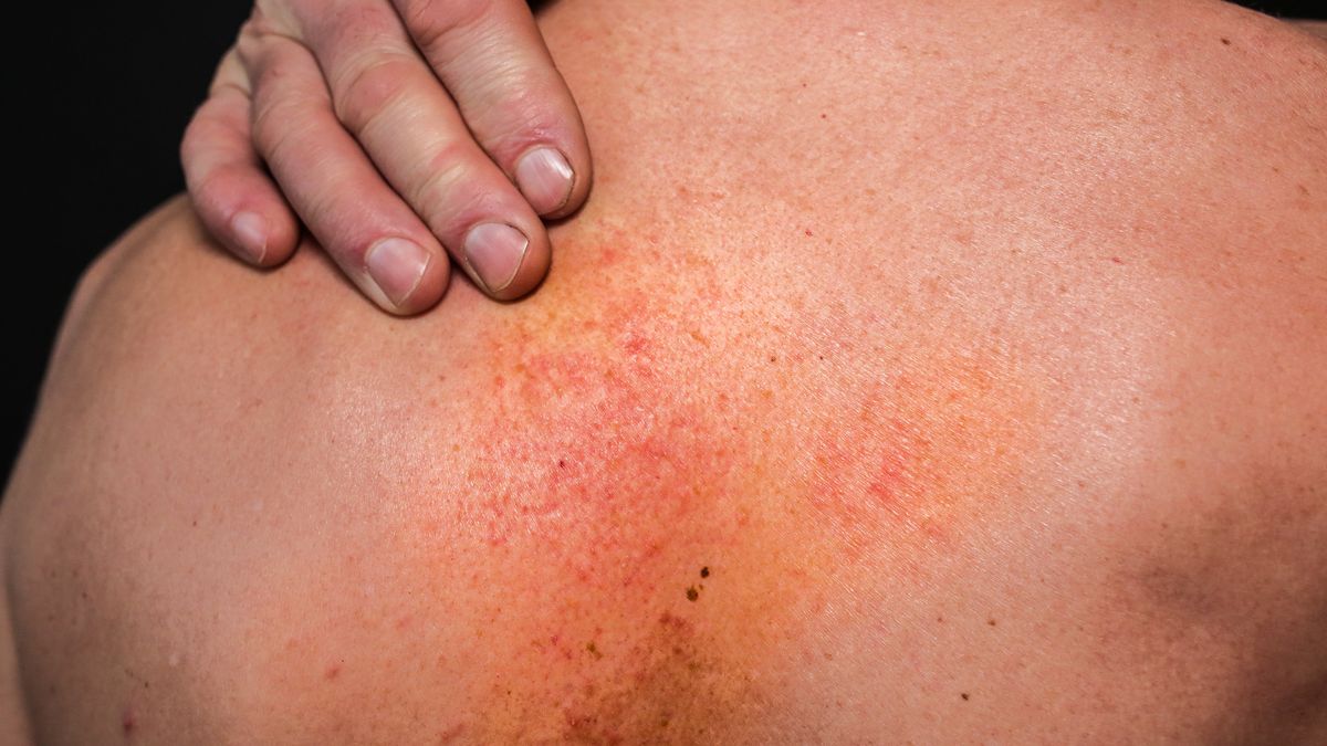 Objawy chorych jelit mogą pojawiać się na skórze