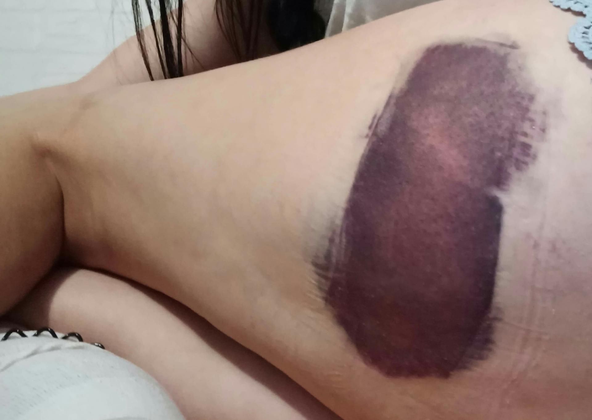 Obrażenie osoby po kolizji samochodowej. Nie miała zapiętych pasów bezpieczeństwa 