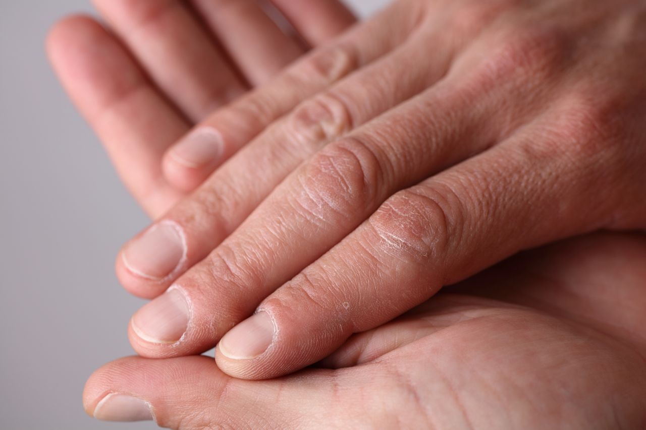 Nails reveal unseen liver woes: Why hand symptoms matter