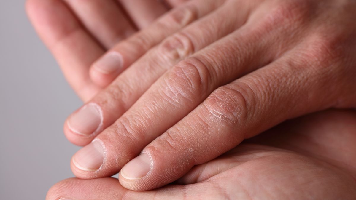 Suche skórki przy paznokciach