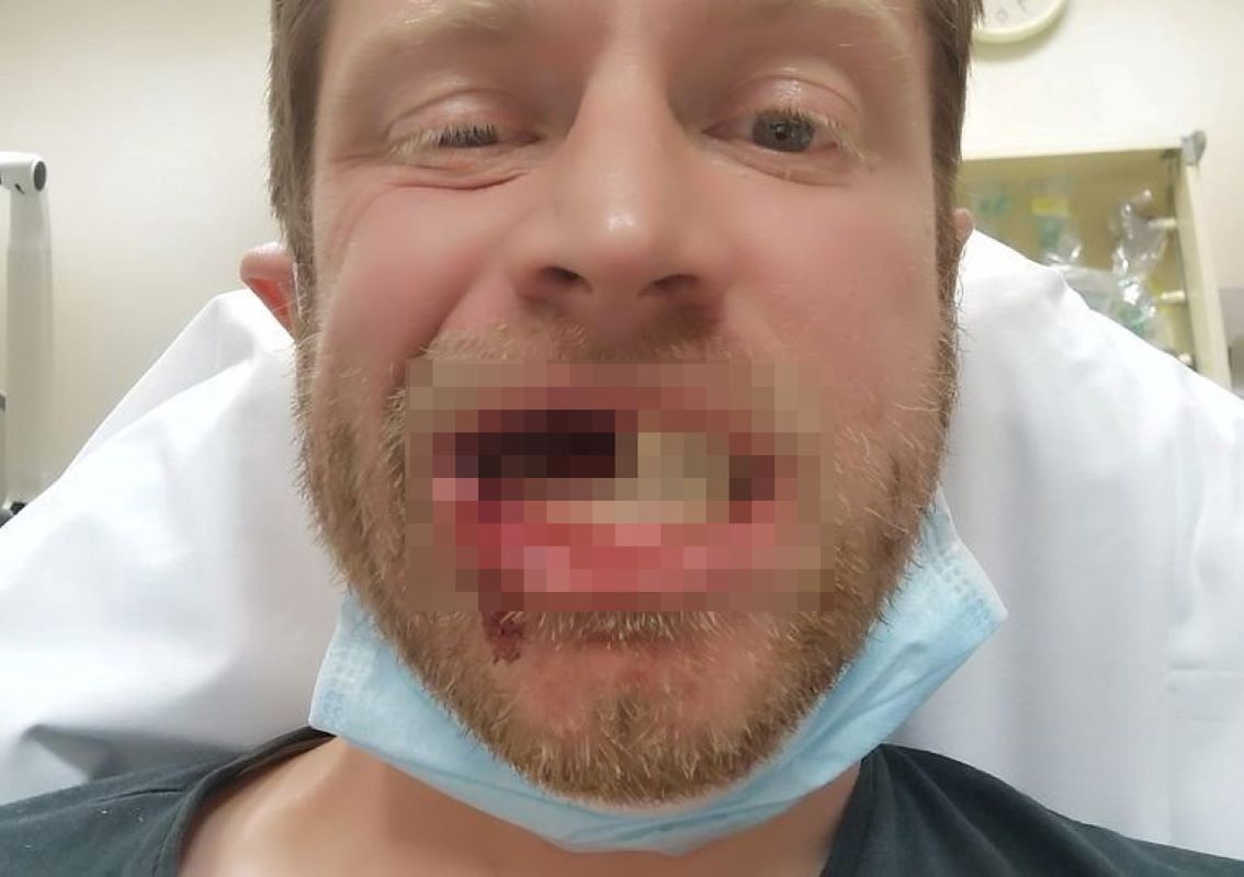 Țigara electronică i-a explodat în gură.  Bărbatul și-a pierdut câțiva dinți – o2