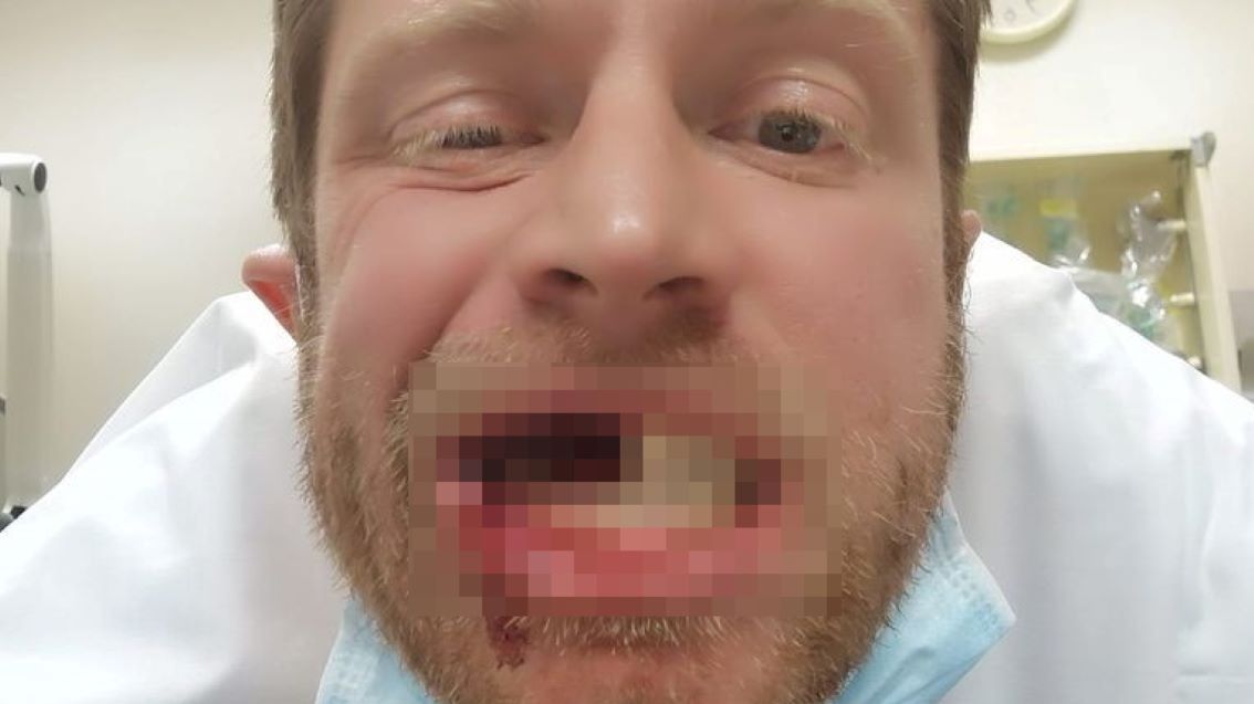 E-papieros eksplodował mężczyźnie w ustach 