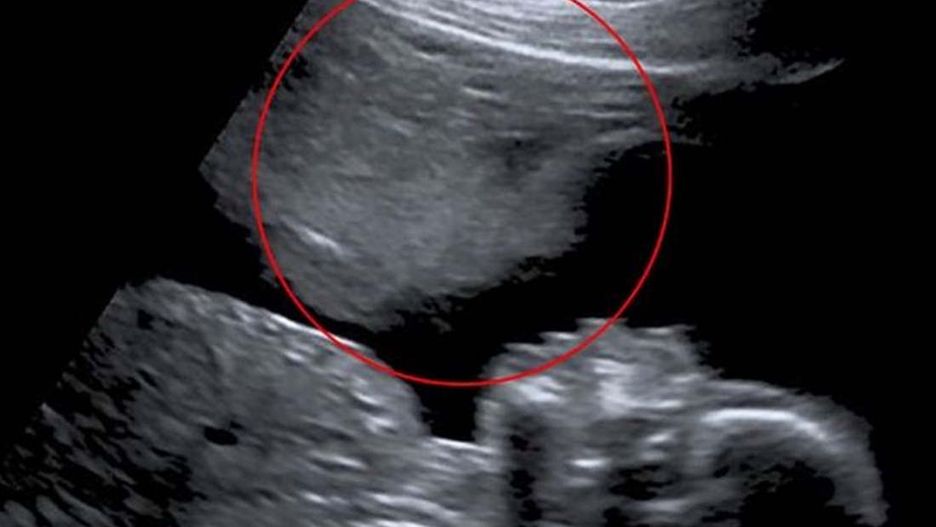 Trzy razy straciła ciążę. To zobaczyła na kolejnym USG