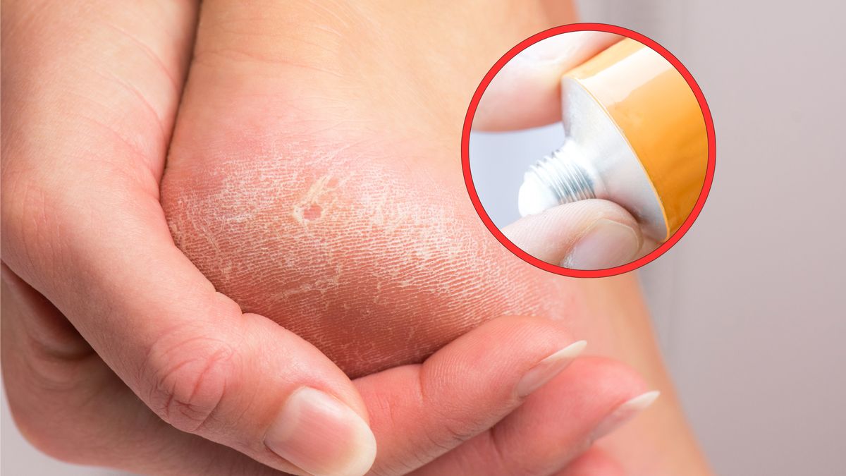 Maść cholesterolowa uratuje przesuszoną skórę 