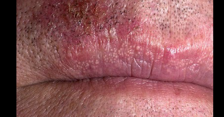 Nietypowy objaw wysokiego cholesterolu. Pojawia się na ustach