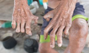 Trąd nadal istnieje. Tak traktuje się chorych w niektórych częściach świata