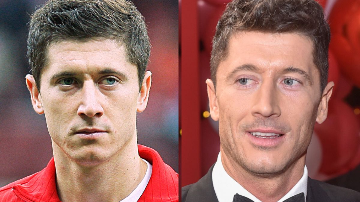 Robert Lewandowski przeszedł operację plastyczną? Krzysztof Gojdź to ocenił