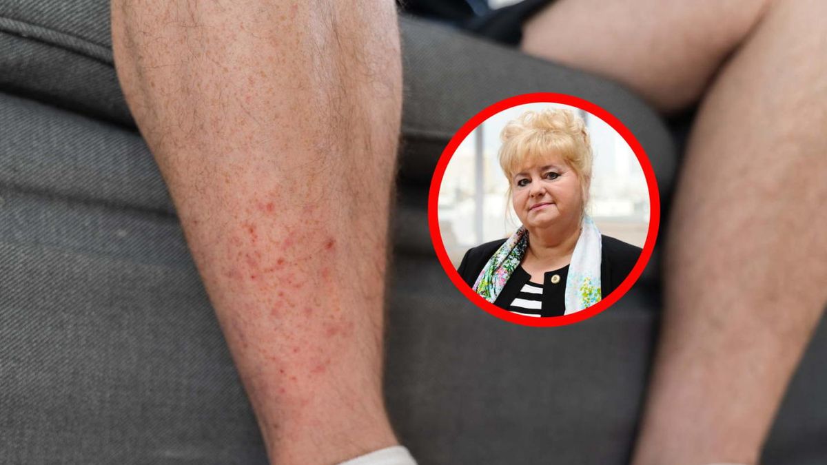 "Atakują całe rodziny". Jednym z objawów może być wysypka na nogach